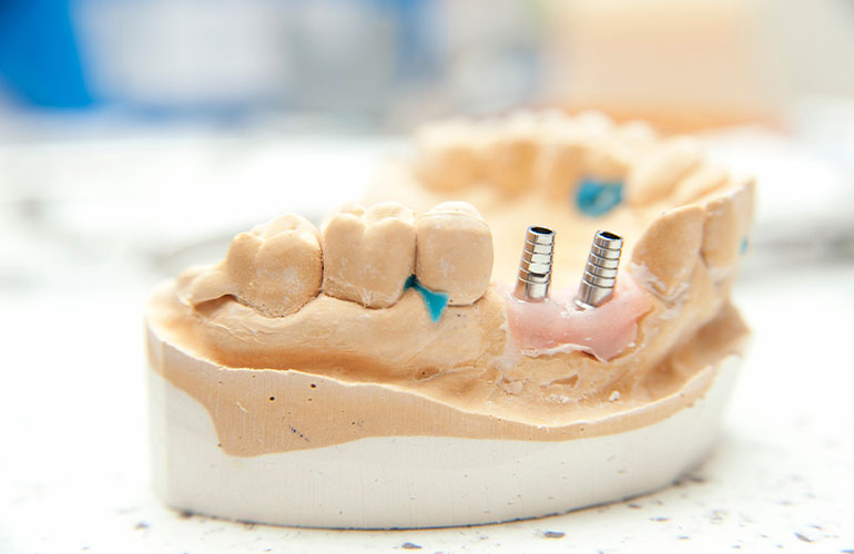 What is Dental Crown?